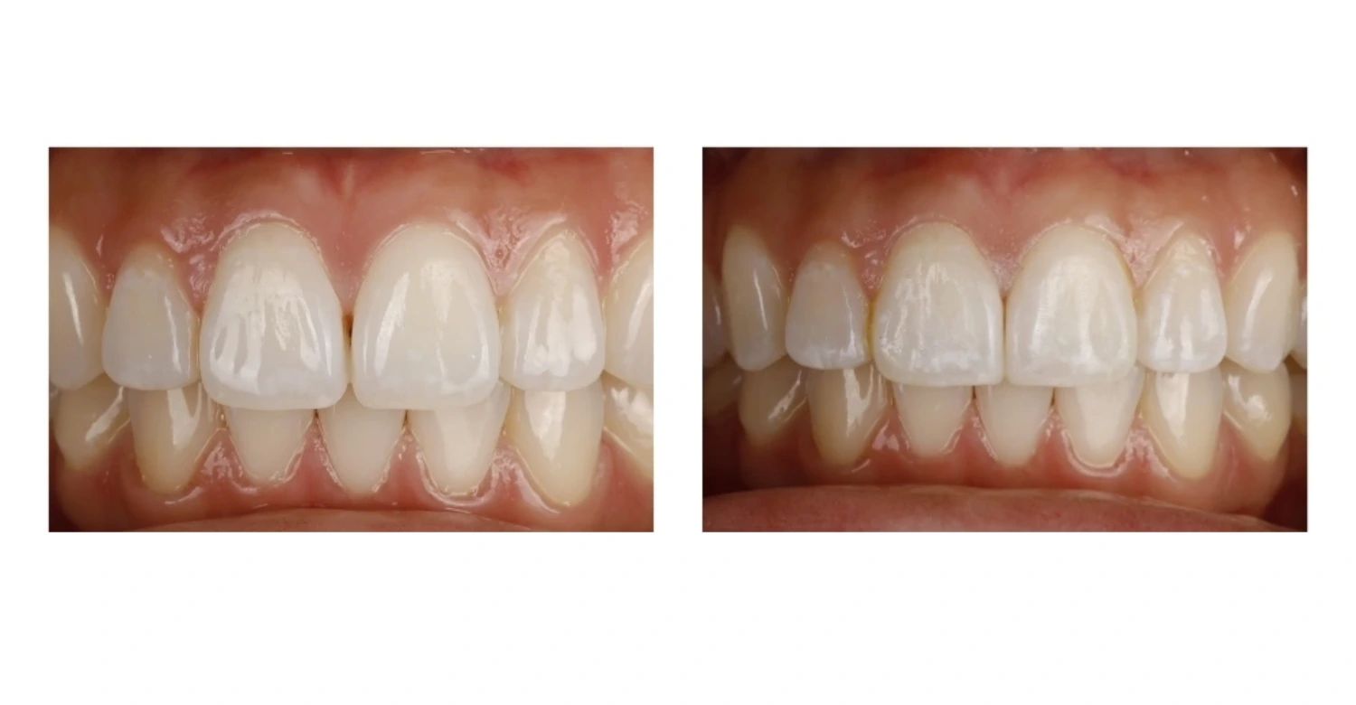 Gum Symmetry and Smile Design 2